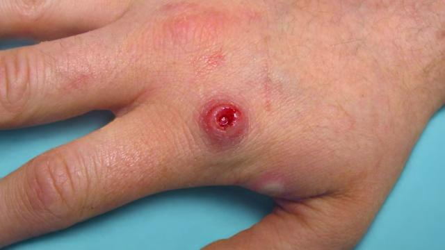 Monkeypox ulertzea eta nola saihestu?